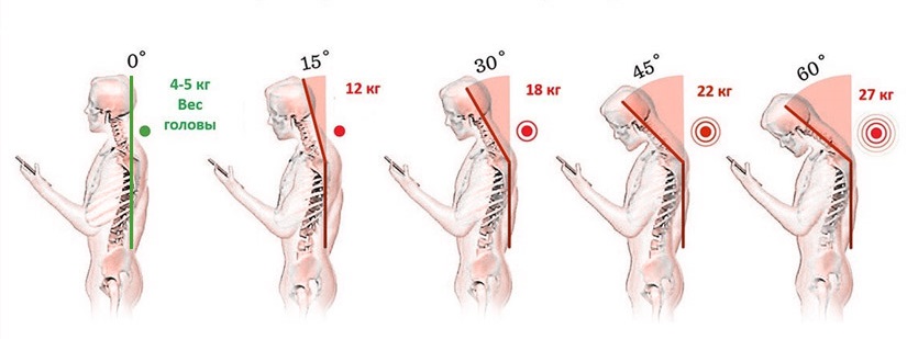 Tech neck. Компьютерная шея. Текстовая шея. Гаджетовая шея