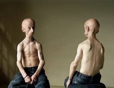 progeria