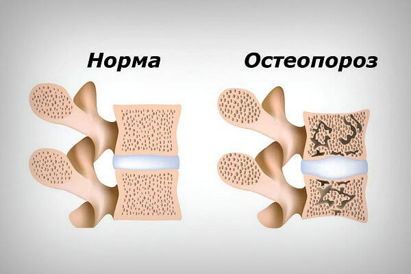 Как выглядит остеопороз