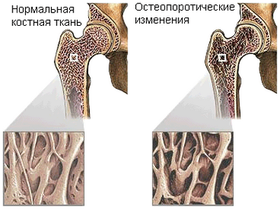 osteoporoz_vnutr